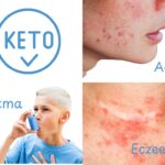 Voeding, astma, acné en eczeem