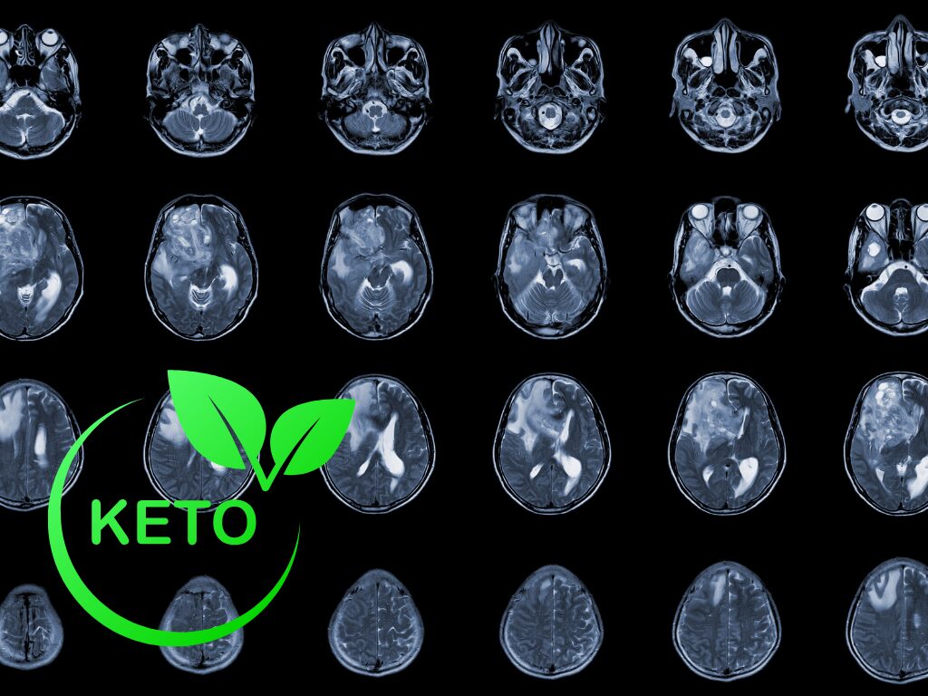 Keto dieet voor neuroblastoma en glioblastoma